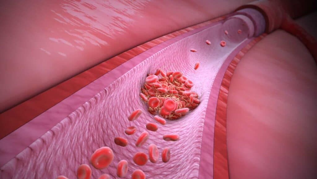 thrombophilia